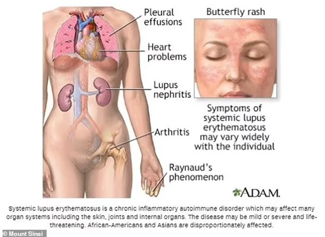 67165431-0-Symptoms_of_lupus_include_pleural_effusions_a_build_up_of_fluid_-a-5_1723202959564_11zon