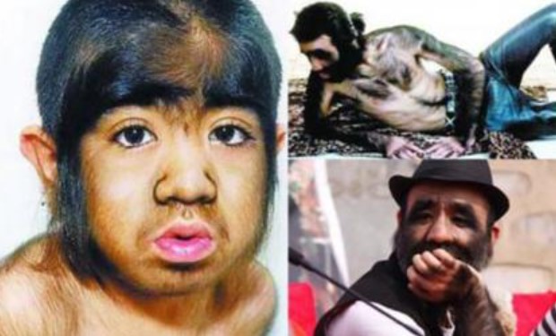 43 năm trước, 'cậu bé người vượn' đã khiến cả một vùng quê xôn xao, tình cảnh hiện tại của anh ra sao?