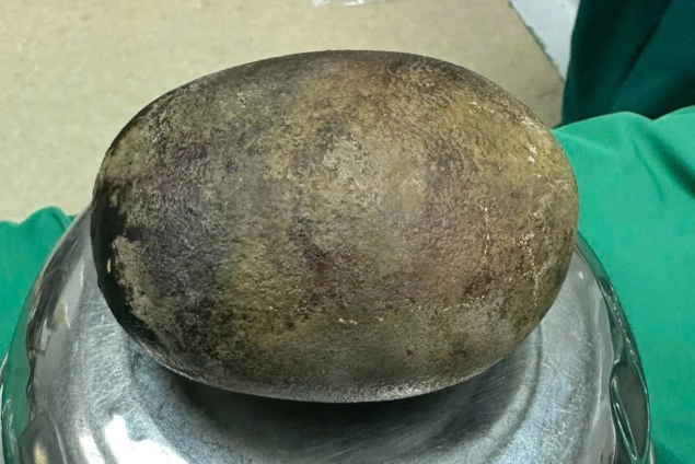 Bác sĩ 20 năm trong nghề ngỡ ngàng khi lấy được viên sỏi nặng... gần 1kg trong bàng quang bệnh nhân