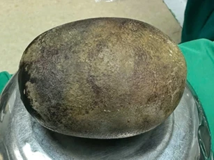 Bác sĩ 20 năm trong nghề ngỡ ngàng khi lấy được viên sỏi nặng... gần 1kg trong bàng quang bệnh nhân