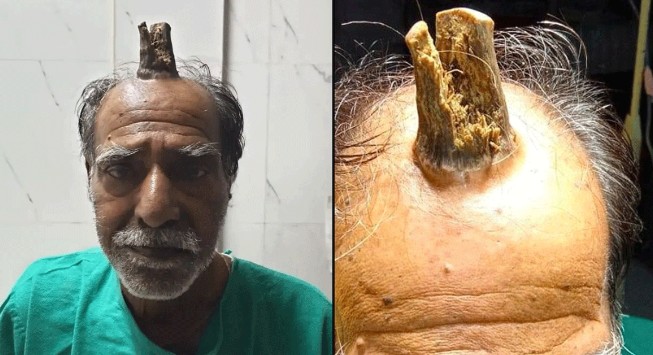 ‘Gốc cây’ cao khoảng 10 cm ‘mọc lên’ từ đầu ông lão 74 tuổi