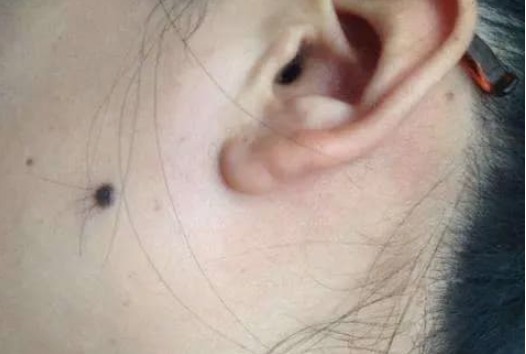 Nốt ruồi lông là tốt hay xấu về mặt tướng số? Có nên nhổ lông trên nốt ruồi không?