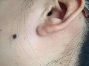 Nốt ruồi lông là tốt hay xấu về mặt tướng số? Có nên nhổ lông trên nốt ruồi không?