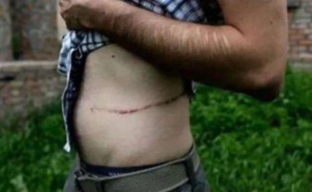 Làng bán thận ở Nepal: Dân làng tin rằng thận sẽ mọc lại sau khi bị cắt và ai cũng có vết sẹo trên cơ thể