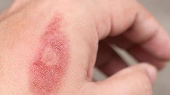 Sai lầm khi chườm đá lên vết bỏng, hướng dẫn chi tiết 5 bước sơ cứu vết bỏng hiệu quả