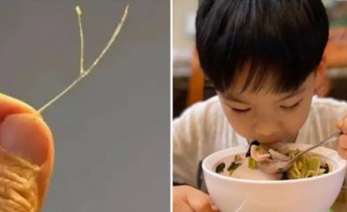 Chữa hóc xương cá bằng cách nuốt miếng cơm lớn là sai, hãy làm theo khoa học, đơn giản mà xương ra tức thì