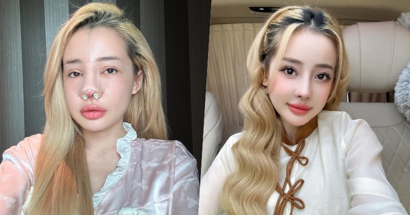 Ngân 98 chi số tiền khủng sửa mũi lần thứ 11, nói về lý do liên tục “dao kéo” thay đổi diện mạo