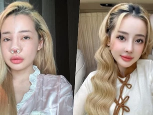 Ngân 98 chi số tiền khủng sửa mũi lần thứ 11, nói về lý do liên tục “dao kéo” thay đổi diện mạo