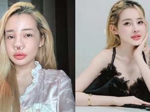 Ngân 98 chi 200 triệu sửa mũi lần thứ 11, diện mạo hiện tại khiến dân tình ngỡ ngàng