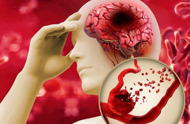 Đây là nhóm máu có nguy cơ bị đột quỵ cao nhất thế giới, đông thứ ba tại Việt Nam