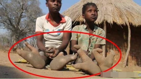 Bộ tộc 'đà điểu' gốc Phi chỉ có 2 ngón chân, các chuyên gia đã đến để tiết lộ sự thật