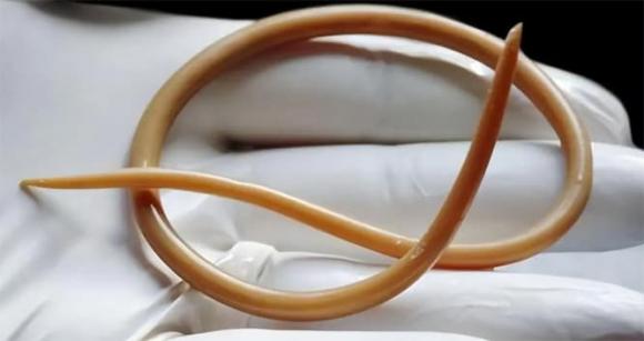 Cách đây vài chục năm, hầu hết mọi người đều có giun đũa trong bụng, tại sao bây giờ người ta ít nghe nói đến?