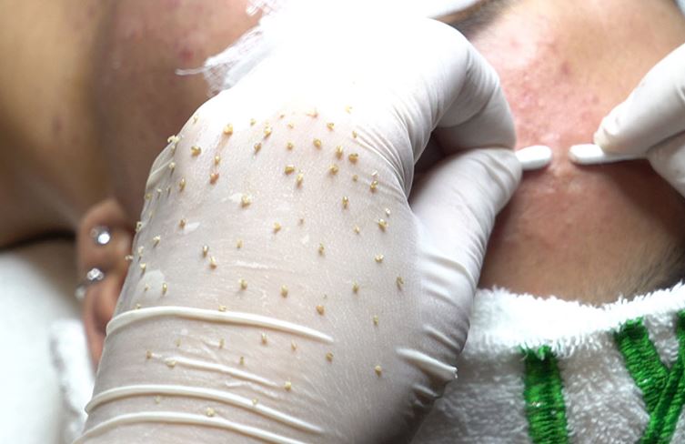 Vì sao hàng triệu người "nghiện" xem clip nặn mụn?