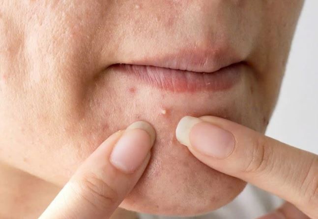 Vì sao những clip nặn mụn đáng sợ lại thu hút hàng triệu lượt xem? Chuyên gia lý giải hiện tượng gây tranh cãi