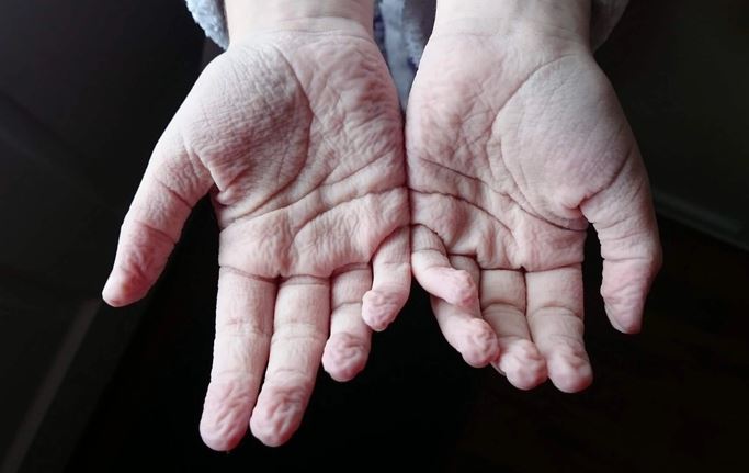 Lý giải bất ngờ về hiện tượng ngón tay nhăn nheo khi ngâm nước lâu