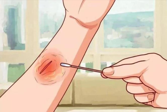 Con người chữa lành vết thương chậm hơn gấp ba lần so với họ hàng linh trưởng gần nhất