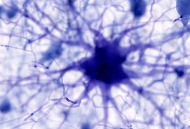 AI phát hiện ra nguyên nhân gây bệnh Alzheimer và có thể tìm ra phương pháp điều trị