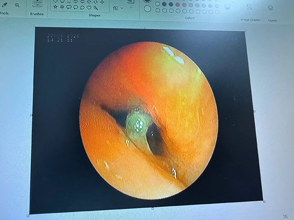 Hình ảnh nội soi phát hiện dị vật trong phế quản của cụ bà L.T.T.R. Hình ảnh nội soi phát hiện dị vật trong phế quản của cụ bà L.T.T.R.