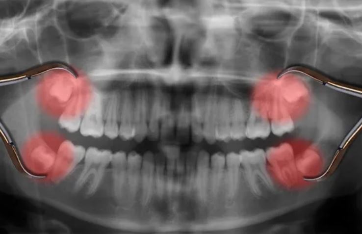 Tại sao răng khôn lại mọc muộn?