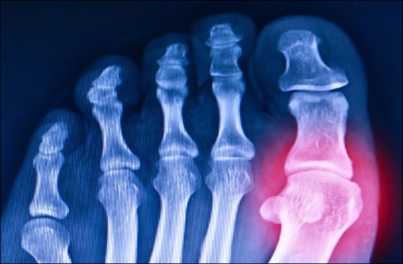 Các nhà khoa học ‘hồi sinh’ gen 20 triệu năm tuổi giúp chống lại bệnh gout