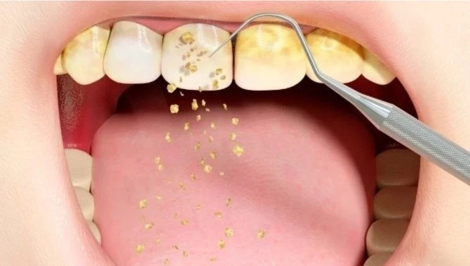 Bạn có thể gặp nhiều rắc rối nếu không đi lấy cao răng.