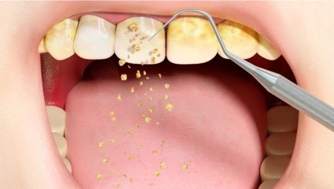 Chuy&#x1EC7;n g&#xEC; s&#x1EBD; x&#x1EA3;y ra n&#x1EBF;u kh&#xF4;ng l&#x1EA5;y cao r&#x103;ng?