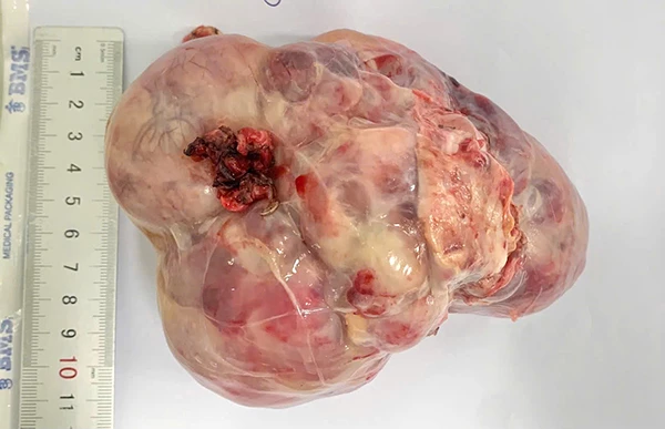 Các khối u lấy ra từ ổ bụng của trẻ em.