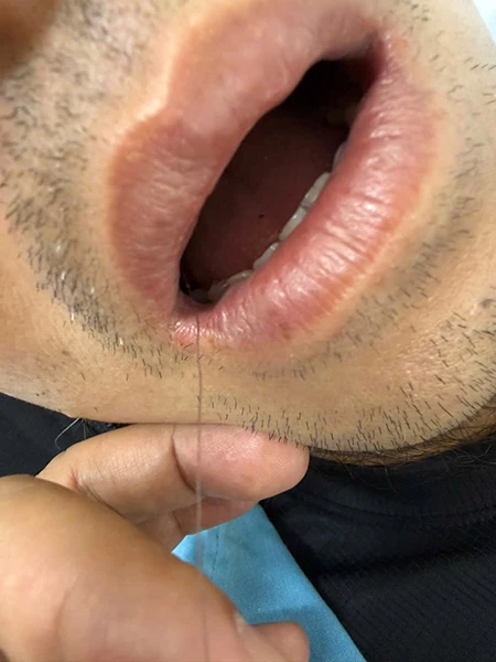 Bệnh nhân bị lưỡi câu nằm sâu trong cổ họng, phần dây cước lòi ra ngoài miệng.