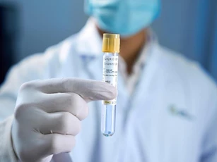 Xét nghiệm máu tầm soát đa ung thư SPOT-MAS 10 được FDA Hoa Kỳ công nhận