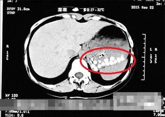 Kết quả CT scan trân châu trong dạ dày phóng viên