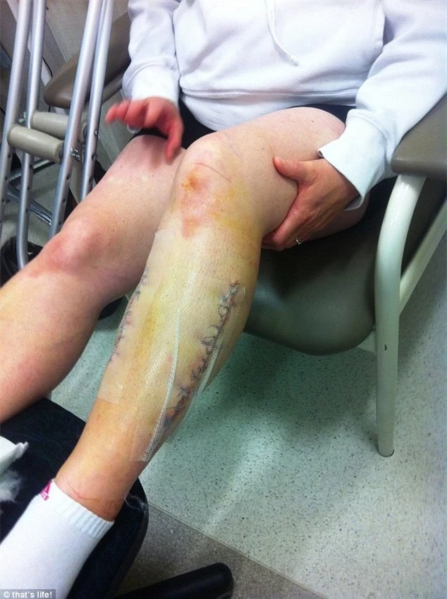các bác sĩ đã rạch một đường dài 20 cm rồi dùng máy bơm chân không để hút chất lỏng ứ đọng bên trong chân.