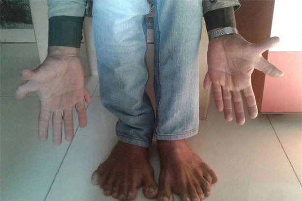 28 ngón chân, ngón tay của anh Suthar đã đi vào kỷ lục Guiness.