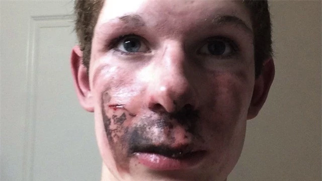 Khuôn mặt của Ty Greer bị biến dạng, đau đớn sau vụ tai nạn.