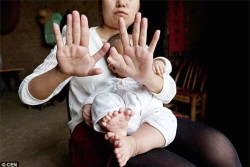 Mẹ của Hồng Hồng cũng bị hội chứng thừa ngón và đây cũng chính là nguyên nhân dẫn tới hiện tượng bất thường của bé Hồng Hồng. hiện tượng bất thường của bé Hồng Hồng.