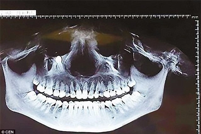Phim chụp X quang cho thấy chiếc răng mọc sai vị trí một cách vô cùng hy hữu.