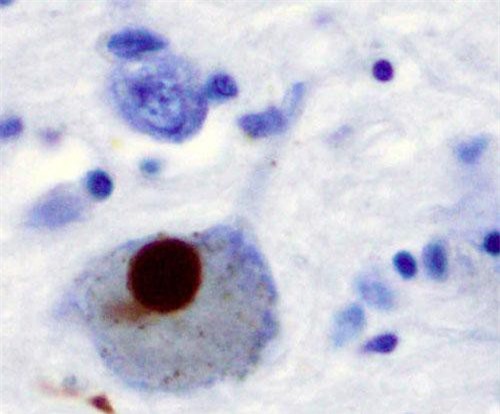 Hướng điều trị mới cho bệnh nhân Parkinson