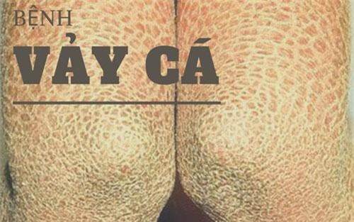 Làm gì khi mắc bệnh vảy cá?