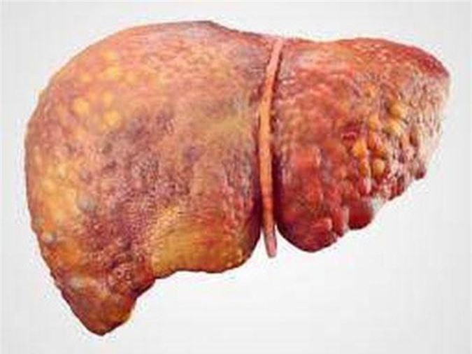 4 dấu hiệu giúp phát hiện ung thư gan