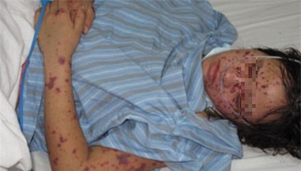 Viêm não mô cầu khiến người khỏe mạnh tử vong trong 1 ngày