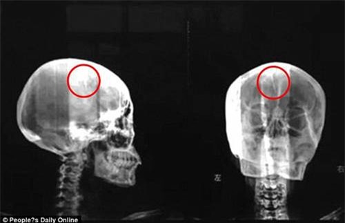 Bàng hoàng phát hiện chiếc kim dài 4,5 cm trong não suốt 46 năm