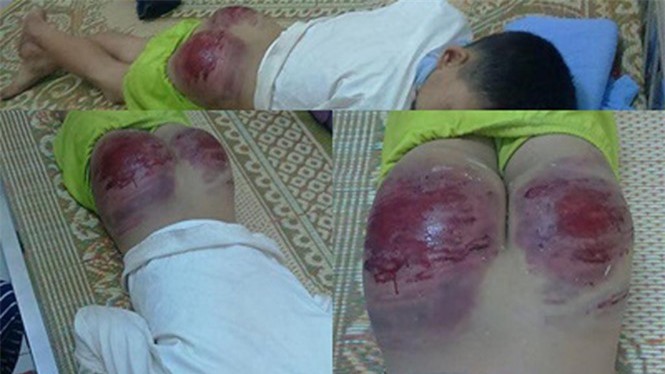 Bố mẹ đánh con phải nhập viện sẽ bị xử lý thế nào?