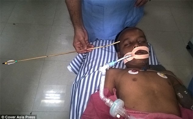 Cậu bé may mắn thoát chết khi bị trúng mũi tên xuyên đầu