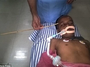 Cậu bé may mắn thoát chết khi bị trúng mũi tên xuyên đầu