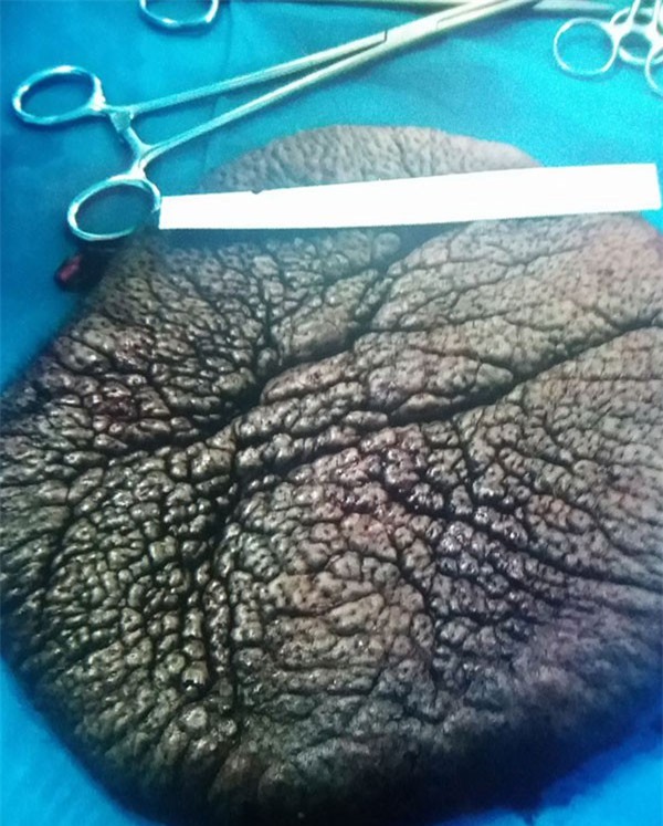 Cô bé ''mai rùa'' đã được mổ tách thành công khối bướu trên lưng nặng 1,5 kg