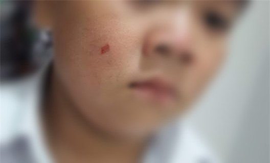 Con bị xước má, phụ huynh vào trường tát giáo viên