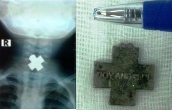 Món đồ chơi hình chữ thập chặn ngang cổ họng bé trai 3 tuổi