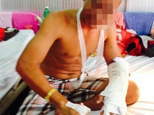 Nam thanh niên quê ở Trà Vinh bị anh họ chặt rớt bàn tay trái