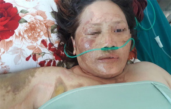 Phú Yên: Thuê cháu tạt axit vào mặt người tình