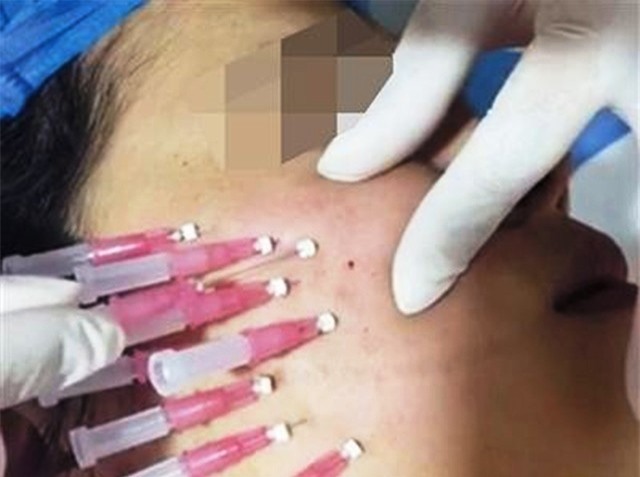 Trung Quốc: Chỉ mất bốn 4 ngày để trở thành bác sĩ thẩm mỹ