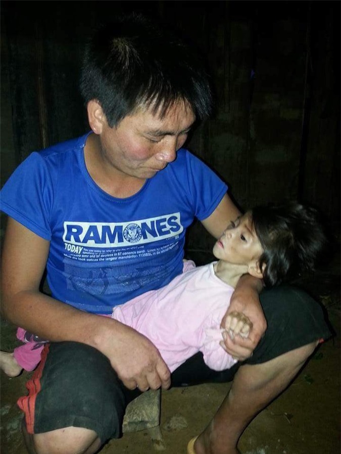 Xót xa bé gái 14 tháng tuổi ở Lào Cai chỉ nặng 3,5kg vì đói